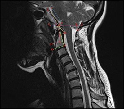 Effect of modified clivoaxial angle on surgical decision making and treatment outcomes in patients with Chiari malformation type 1